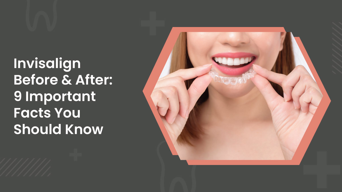 Invisalign Facts
