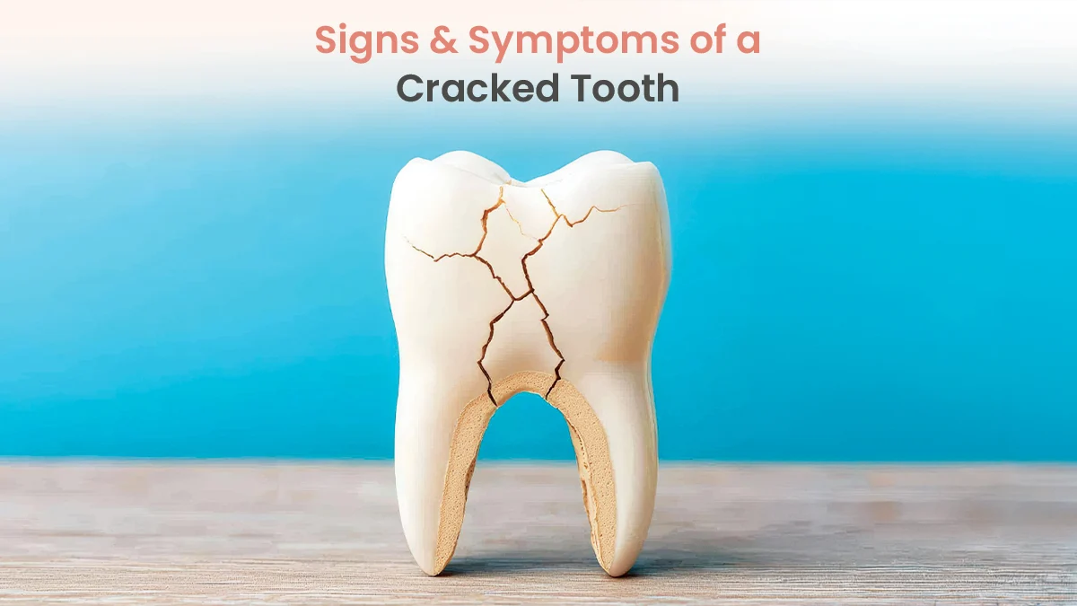 Cracked Tooth Symptoms: When Do You Need Treatment?